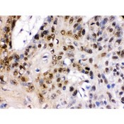 TCF7L1 / TCF-3 Antibody - TCF7L1 was detected in paraffin-embedded sections of human esophagus squama cancer tissues using rabbit anti- TCF7L1 Antigen Affinity purified polyclonal antibody at 1 ug/mL. The immunohistochemical section was developed using SABC method.