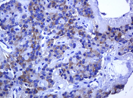 TCL / RHOJ Antibody - IHC of paraffin-embedded Carcinoma of Human pancreas tissue using anti-RHOJ mouse monoclonal antibody. (Heat-induced epitope retrieval by 10mM citric buffer, pH6.0, 120°C for 3min).