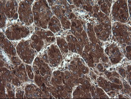 TCL / RHOJ Antibody - IHC of paraffin-embedded Carcinoma of Human liver tissue using anti-RHOJ mouse monoclonal antibody. (Heat-induced epitope retrieval by 10mM citric buffer, pH6.0, 120°C for 3min).