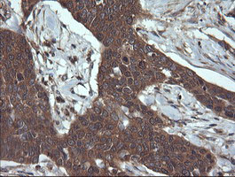 TCL / RHOJ Antibody - IHC of paraffin-embedded Carcinoma of Human bladder tissue using anti-RHOJ mouse monoclonal antibody. (Heat-induced epitope retrieval by 10mM citric buffer, pH6.0, 120°C for 3min).