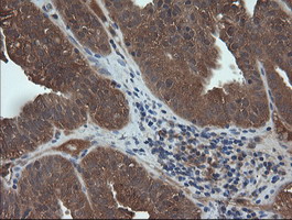 TCL / RHOJ Antibody - IHC of paraffin-embedded Adenocarcinoma of Human ovary tissue using anti-RHOJ mouse monoclonal antibody. (Heat-induced epitope retrieval by 10mM citric buffer, pH6.0, 120°C for 3min).