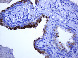 TCL / RHOJ Antibody - IHC of paraffin-embedded Carcinoma of Human prostate tissue using anti-RHOJ mouse monoclonal antibody. (Heat-induced epitope retrieval by 10mM citric buffer, pH6.0, 120°C for 3min).