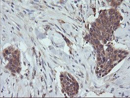 TCL / RHOJ Antibody - IHC of paraffin-embedded Carcinoma of Human bladder tissue using anti-RHOJ mouse monoclonal antibody.