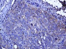 TCL / RHOJ Antibody - IHC of paraffin-embedded Adenocarcinoma of Human ovary tissue using anti-RHOJ mouse monoclonal antibody.