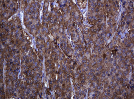TCL / RHOJ Antibody - IHC of paraffin-embedded Carcinoma of Human thyroid tissue using anti-RHOJ mouse monoclonal antibody.