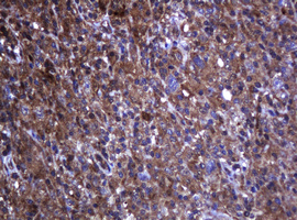 TCL / RHOJ Antibody - IHC of paraffin-embedded Human lymphoma tissue using anti-RHOJ mouse monoclonal antibody.