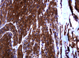 TCL / RHOJ Antibody - IHC of paraffin-embedded Carcinoma of Human thyroid tissue using anti-RHOJ mouse monoclonal antibody. (Heat-induced epitope retrieval by 10mM citric buffer, pH6.0, 120°C for 3min).