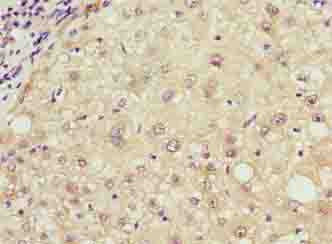 TCL / RHOJ Antibody - Immunohistochemistry of paraffin-embedded human liver cancer using antibody at dilution of 1:100.
