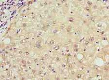 TCL / RHOJ Antibody - Immunohistochemistry of paraffin-embedded human liver cancer using antibody at dilution of 1:100.