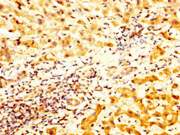TCP1 Antibody - Immunohistochemistry image at a dilution of 1:800 and staining in paraffin-embedded human liver cancer performed on a Leica BondTM system. After dewaxing and hydration, antigen retrieval was mediated by high pressure in a citrate buffer (pH 6.0) . Section was blocked with 10% normal goat serum 30min at RT. Then primary antibody (1% BSA) was incubated at 4 °C overnight. The primary is detected by a biotinylated secondary antibody and visualized using an HRP conjugated SP system.
