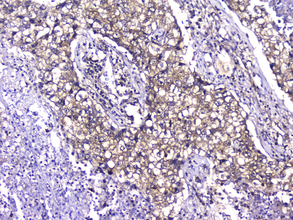 TCP1 Antibody - IHC analysis of TCP1 alpha using anti-TCP1 alpha antibody. TCP1 alpha was detected in paraffin-embedded section of human lung cancer tissue. Heat mediated antigen retrieval was performed in citrate buffer (pH6, epitope retrieval solution) for 20 mins. The tissue section was blocked with 10% goat serum. The tissue section was then incubated with 2µg/ml mouse anti-TCP1 alpha Antibody overnight at 4°C. Biotinylated goat anti-mouse IgG was used as secondary antibody and incubated for 30 minutes at 37°C. The tissue section was developed using Strepavidin-Biotin-Complex (SABC) with DAB as the chromogen.