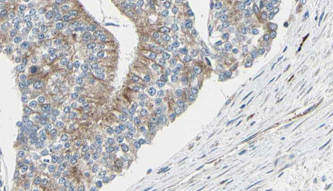 TCP1 Antibody - 1:100 staining human prostate tissue by IHC-P. The sample was formaldehyde fixed and a heat mediated antigen retrieval step in citrate buffer was performed. The sample was then blocked and incubated with the antibody for 1.5 hours at 22°C. An HRP conjugated goat anti-rabbit antibody was used as the secondary.