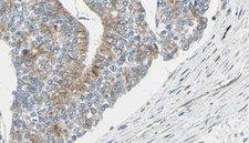 TCP1 Antibody - 1:100 staining human prostate tissue by IHC-P. The sample was formaldehyde fixed and a heat mediated antigen retrieval step in citrate buffer was performed. The sample was then blocked and incubated with the antibody for 1.5 hours at 22°C. An HRP conjugated goat anti-rabbit antibody was used as the secondary.