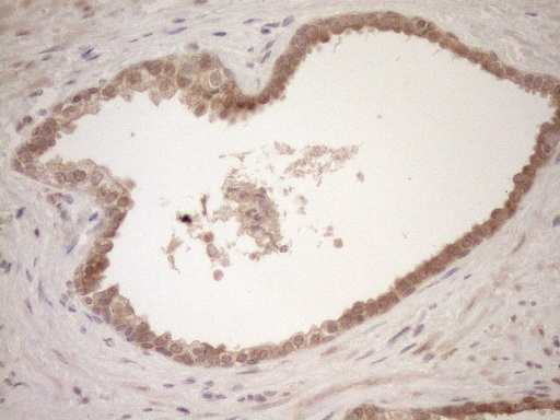 TCP10 Antibody - Immunohistochemical staining of paraffin-embedded Carcinoma of Human prostate tissue using anti-TCP10 mouse monoclonal antibody. (Heat-induced epitope retrieval by 1mM EDTA in 10mM Tris buffer. (pH8.5) at 120°C for 3 min. (1:150)