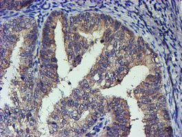 TCP11L2 Antibody - IHC of paraffin-embedded Adenocarcinoma of Human endometrium tissue using anti-TCP11L2 mouse monoclonal antibody. (Heat-induced epitope retrieval by 10mM citric buffer, pH6.0, 100C for 10min).