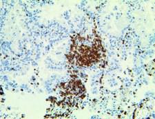 TCR Alpha Antibody - IHC of TCR Alpha on an FFPE Lung Adenocarcinoma Tissue