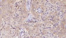 TCTN2 Antibody - 1:100 staining human thyroid carcinoma tissue by IHC-P. The sample was formaldehyde fixed and a heat mediated antigen retrieval step in citrate buffer was performed. The sample was then blocked and incubated with the antibody for 1.5 hours at 22°C. An HRP conjugated goat anti-rabbit antibody was used as the secondary.