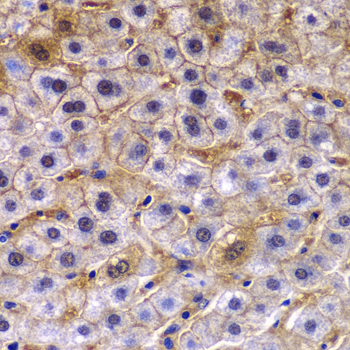 TCTN3 Antibody - Immunohistochemistry of paraffin-embedded human liver cancer using TCTN3 antibodyat dilution of 1:100 (40x lens).