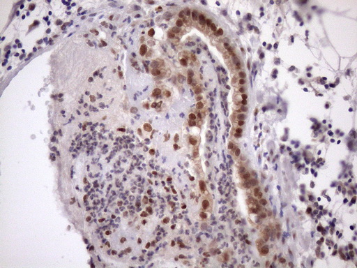 TDG / Thymine DNA Glycosylase Antibody - Immunohistochemical staining of paraffin-embedded Carcinoma of Human pancreas tissue using anti-TDG mouse monoclonal antibody. (Heat-induced epitope retrieval by 1mM EDTA in 10mM Tris buffer. (pH8.5) at 120 oC for 3 min. (1:150)
