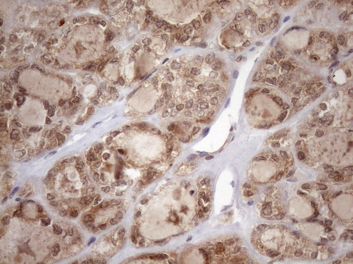 TDG / Thymine DNA Glycosylase Antibody - Immunohistochemical staining of paraffin-embedded Carcinoma of Human thyroid tissue using anti-TDG mouse monoclonal antibody. (Heat-induced epitope retrieval by 1mM EDTA in 10mM Tris buffer. (pH8.5) at 120 oC for 3 min. (1:150)