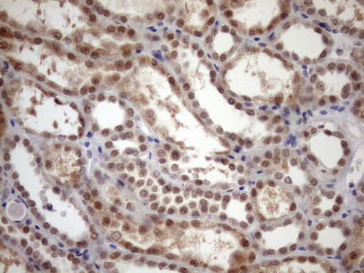 TDG / Thymine DNA Glycosylase Antibody - Immunohistochemical staining of paraffin-embedded Adenocarcinoma of Human colon tissue using anti-TDG mouse monoclonal antibody. (Heat-induced epitope retrieval by 1mM EDTA in 10mM Tris buffer. (pH8.5) at 120 oC for 3 min. (1:150)