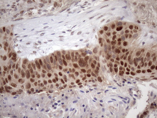 TDG / Thymine DNA Glycosylase Antibody - Immunohistochemical staining of paraffin-embedded Carcinoma of Human lung tissue using anti-TDG mouse monoclonal antibody. (Heat-induced epitope retrieval by 1mM EDTA in 10mM Tris buffer. (pH8.5) at 120 oC for 3 min. (1:150)