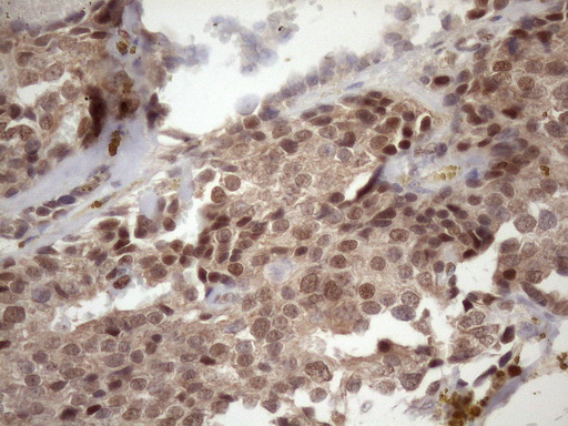 TDG / Thymine DNA Glycosylase Antibody - Immunohistochemical staining of paraffin-embedded Adenocarcinoma of Human breast tissue using anti-TDG mouse monoclonal antibody. (Heat-induced epitope retrieval by 1mM EDTA in 10mM Tris buffer. (pH8.5) at 120 oC for 3 min. (1:150)