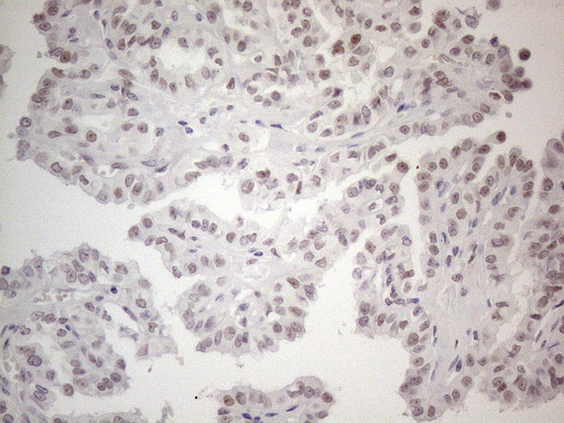 TDG / Thymine DNA Glycosylase Antibody - Immunohistochemical staining of paraffin-embedded Carcinoma of Human thyroid tissue using anti-TDG mouse monoclonal antibody. (Heat-induced epitope retrieval by 1mM EDTA in 10mM Tris buffer. (pH8.5) at 120°C for 3 min. (1:150)