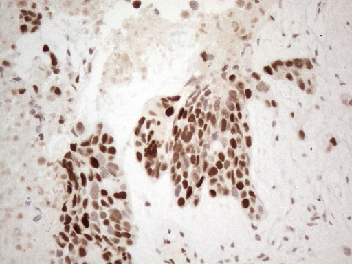 TDG / Thymine DNA Glycosylase Antibody - Immunohistochemical staining of paraffin-embedded Adenocarcinoma of Human endometrium tissue using anti-TDG mouse monoclonal antibody. (Heat-induced epitope retrieval by 1mM EDTA in 10mM Tris buffer. (pH8.5) at 120°C for 3 min. (1:150)