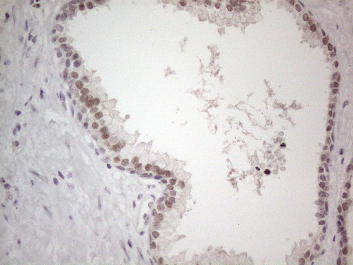 TDG / Thymine DNA Glycosylase Antibody - Immunohistochemical staining of paraffin-embedded Carcinoma of Human prostate tissue using anti-TDG mouse monoclonal antibody. (Heat-induced epitope retrieval by 1mM EDTA in 10mM Tris buffer. (pH8.5) at 120°C for 3 min. (1:150)