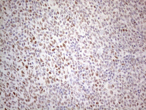TDG / Thymine DNA Glycosylase Antibody - Immunohistochemical staining of paraffin-embedded Human lymphoma tissue using anti-TDG mouse monoclonal antibody. (Heat-induced epitope retrieval by 1mM EDTA in 10mM Tris buffer. (pH8.5) at 120°C for 3 min. (1:150)