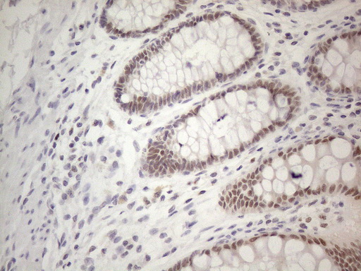 TDG / Thymine DNA Glycosylase Antibody - Immunohistochemical staining of paraffin-embedded Human colon tissue within the normal limits using anti-TDG mouse monoclonal antibody. (Heat-induced epitope retrieval by 1mM EDTA in 10mM Tris buffer. (pH8.5) at 120°C for 3 min. (1:150)