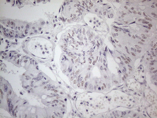 TDG / Thymine DNA Glycosylase Antibody - Immunohistochemical staining of paraffin-embedded Adenocarcinoma of Human colon tissue using anti-TDG mouse monoclonal antibody. (Heat-induced epitope retrieval by 1mM EDTA in 10mM Tris buffer. (pH8.5) at 120°C for 3 min. (1:150)