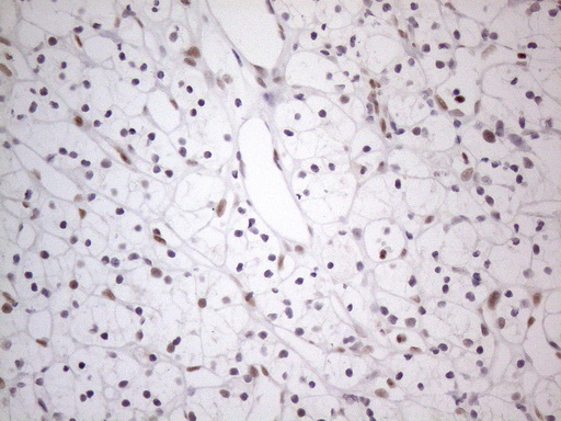 TDG / Thymine DNA Glycosylase Antibody - Immunohistochemical staining of paraffin-embedded Carcinoma of Human kidney tissue using anti-TDG mouse monoclonal antibody. (Heat-induced epitope retrieval by 1mM EDTA in 10mM Tris buffer. (pH8.5) at 120°C for 3 min. (1:150)