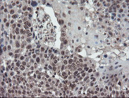 TDO2 Antibody - IHC of paraffin-embedded Carcinoma of Human lung tissue using anti-TDO2 mouse monoclonal antibody.