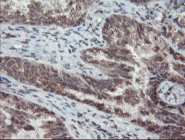 TDO2 Antibody - IHC of paraffin-embedded Adenocarcinoma of Human ovary tissue using anti-TDO2 mouse monoclonal antibody.