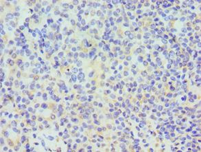 TDP-43 / TARDBP Antibody - Immunohistochemistry of paraffin-embedded human breast cancer using antibody at 1:100 dilution.
