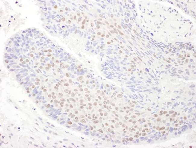 TDP-43 / TARDBP Antibody - Detection of Human TDP43 by Immunohistochemistry. Sample: FFPE section of human non-small cell lung cancer. Antibody: Affinity purified rabbit anti-TDP43 used at a dilution of 1:1000 (0.2 ug/ml). Detection: DAB.