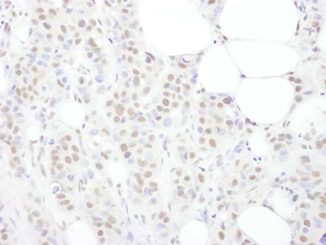 TDP-43 / TARDBP Antibody - Detection of Human TDP43 by Immunohistochemistry. Sample: FFPE section of human breast carcinoma. Antibody: Affinity purified rabbit anti-TDP43 used at a dilution of 1:1000 (0.2 ug/ml). Detection: DAB.