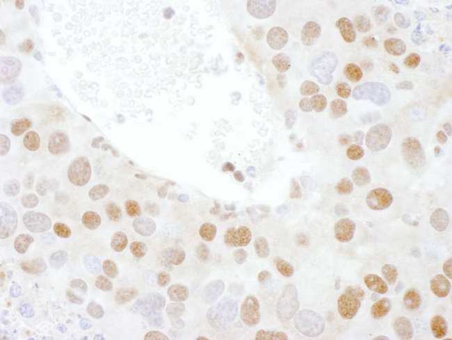 TDP-43 / TARDBP Antibody - Detection of Mouse TDP43 by Immunohistochemistry. Sample: FFPE section of mouse renal cell carcinoma. Antibody: Affinity purified rabbit anti-TDP43 used at a dilution of 1:200 (1 ug/ml). Detection: DAB.