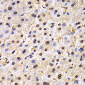 TDP-43 / TARDBP Antibody - Immunohistochemistry of paraffin-embedded human liver cancer tissue.