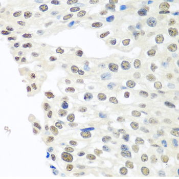 TDP-43 / TARDBP Antibody - Immunohistochemistry of paraffin-embedded human prostate cancer tissue.