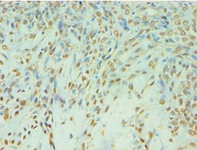 TDP1 Antibody - Immunohistochemistry of paraffin-embedded human breast cancer using antibody at 1:100 dilution.