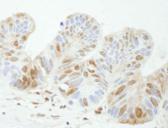 TDP1 Antibody - Detection of Human TDP1 by Immunohistochemistry. Sample: FFPE section of human ovarian tumor. Antibody: Affinity purified rabbit anti-TDP1 used at a dilution of 1:250.