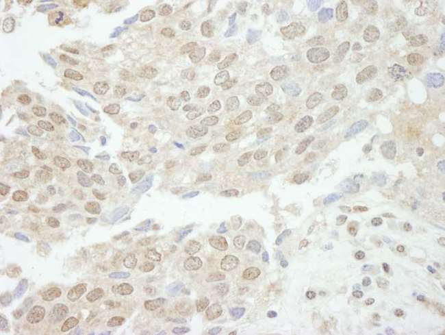 TDP1 Antibody - Detection of Human TDP1 by Immunohistochemistry. Sample: FFPE section of human breast carcinoma. Antibody: Affinity purified rabbit anti-TDP1 used at a dilution of 1:250.