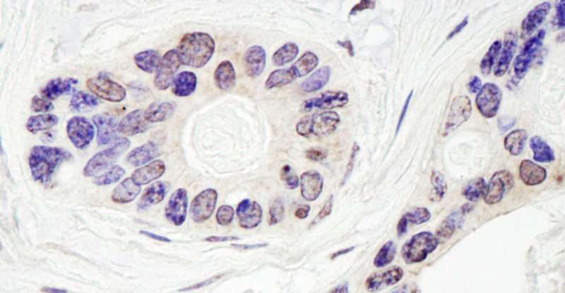 TDP1 Antibody - Detection of Human TDP1 by Immunohistochemistry. Sample: FFPE section of human ovarian carcinoma. Antibody: Affinity purified rabbit anti-TDP1 used at a dilution of 1:1000 (0.2 ug/ml). Detection: DAB.