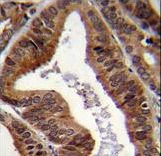 TDP2 / TTRAP Antibody - EAPII Antibody immunohistochemistry of formalin-fixed and paraffin-embedded human prostate carcinoma followed by peroxidase-conjugated secondary antibody and DAB staining.