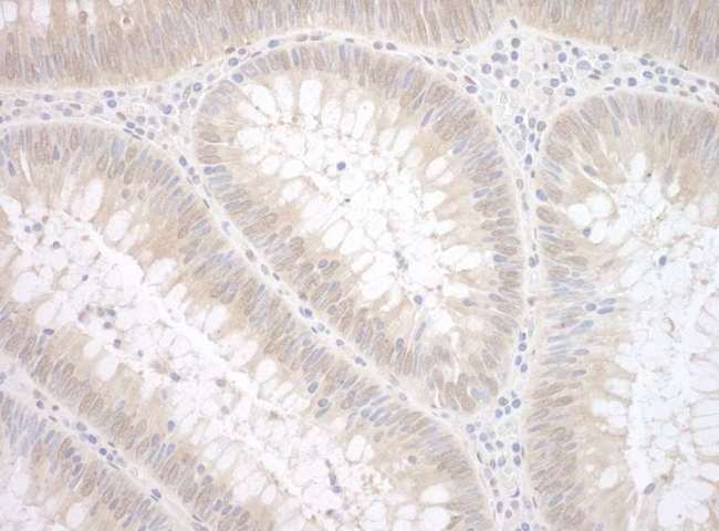 TDP2 / TTRAP Antibody - Detection of Human TDP2 by Immunohistochemistry. Sample: FFPE section of human colon carcinoma. Antibody: Affinity purified rabbit anti-TDP2 used at a dilution of 1:200 (1 ug/mg).