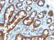 TDP2 / TTRAP Antibody - IHC testing of FFPE human duodenal carcinoma with TDP2 antibody (clone TDP2/1258). Required HIER: boil tissue sections in 10mM Tris with 1mM EDTA, pH 9, for 10-20 min followed by cooling at RT for 20 min.