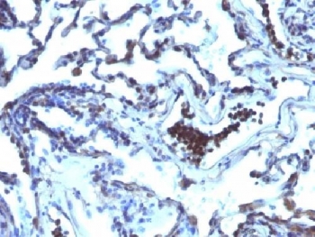 TDP2 / TTRAP Antibody - IHC testing of FFPE human lung carcinoma with TDP2 antibody (clone TDP2/1258). Required HIER: boil tissue sections in 10mM Tris with 1mM EDTA, pH 9, for 10-20 min followed by cooling at RT for 20 min.